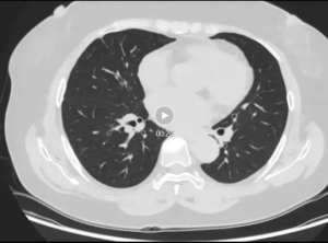 Case Sharing | Cryosurgical System for Lung Cancer