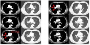Case Sharing | Cryosurgical System for Lung Metastatic Malignant Tumors