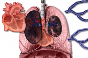 Chronic Thromboembolic Pulmonary Hypertension  Market Expands Rapidly Due to Advanced Surg