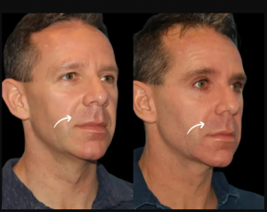 Real Results: Best Doctors in Dubai for Sculptra Fillers