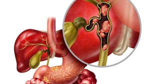 Intrahepatic Cholangiocarcinoma Market Expands Rapidly Due to Advanced Therapeutic Solutions