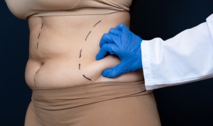 Don’t Just Lose Fat—Shape Your Best Self with Liposuction