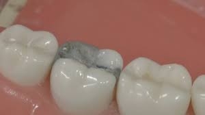 A Closer Look at the Role of Bonding Cement in Dentistry