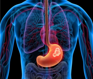 Global Gastrointestinal Stromal Tumor (GIST) Market Grows with Advanced Treatment Solutions