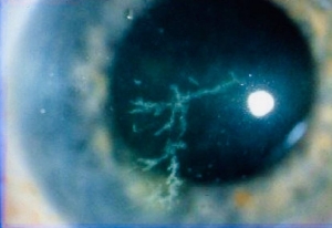 Neurotrophic Keratitis Treatment Market Expands Rapidly Due to Rising Demand for Innovative Therapeutic Solutions