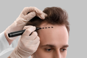 Best Hair Transplant Clinics in Islamabad for 2025