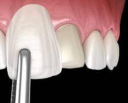 Composite Veneers Maintenance, Tips for a Lasting Smile