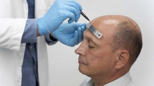 Considering a Hair Transplant in Pune? Here’s What You Should Know