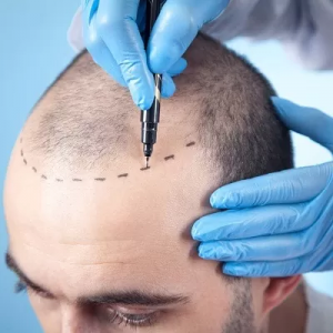 How Dubai Became a Hotspot for Advanced Hair Transplant Technology