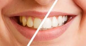 Gentle Dental Scaling for a Healthier Mouth