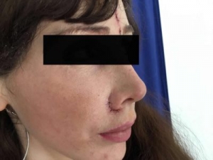 The Subtle Art of the Thread Lift: Rejuvenation Without Surgery’s Rigors