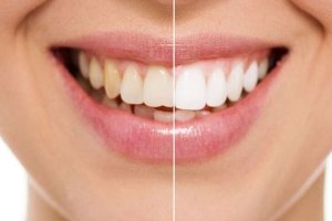 Teeth Whitening for Coffee Lovers, Your Game Plan