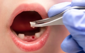 Tooth Removal, The Key to Restoring YourSmile