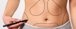 Liposuction for the Body You’ve Been Dreaming Of