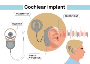 Cochlear Implants Market Set for Consistent 7.0% CAGR, Projected to Hit $5.70 Billion by 2035