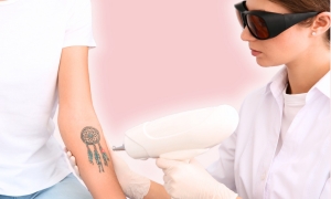 Laser Tattoo Removal: Clear Your Skin, Unlock Your Glow!