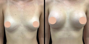 Best Breast Augmentation Surgeon in Dubai: Who Specializes in Natural-Looking Enhancements