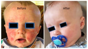 Gentle, Effective Body Creams for Eczema Relief