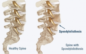 Understanding Spondylolisthesis: How it Affects the Spine and How to Treat It