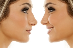 How Soon After Rhinoplasty Can I Start Exercising Again in Dubai