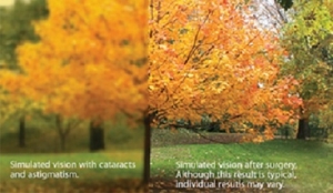 Seeing Clearly Again: Cataract Surgery Options at The Eye Center in Columbia, SC