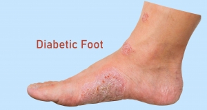 What are the 5 stages of diabetic foot?
