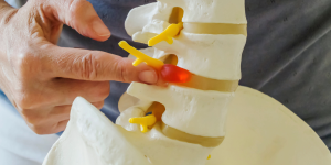 Spinal Cord Abscess: Why Delaying Treatment Can Be Life-Threatening | Best Spine Doctor in Delhi