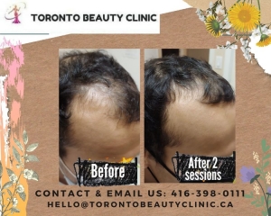 How Post Hair Transplant PRP Treatment Helps Your Hair Grow After Transplant
