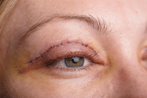 Why Is Eyelid Surgery in Mumbai Gaining So Much Popularity?