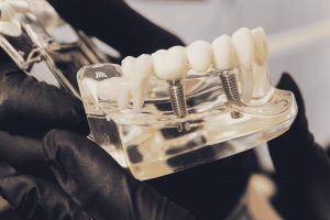 Discover the Benefits of Dental Implants in Mountain Ash: A Smile That Lasts