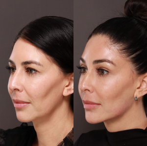 Rhinoplasty Chicago IL: A Comprehensive Guide to Refined Nasal Harmony