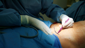 How to Plan for the Cost of Abdominoplasty in Mumbai?