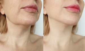 Chin Liposuction in Chicago: A Definitive Guide to Submental Sculpting