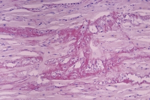 Cardiac Amyloidosis Market is Anticipated to Witness High Growth Owing to Rising Prevalence of Cardiovascular Diseases