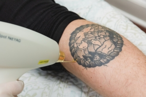 How Laser Tattoo Removal Clears Ink for Smooth, Clear Skin