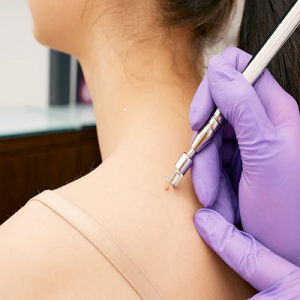 Exploring Laser Skin Tag Removal Treatments in Dubai