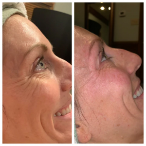 How to Use Derma E Stem Cell Eye Treatment Effectively