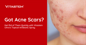Got Acne Scars? Get Rid of Them with Vitastem Ultra’s Topical Antibiotic Spray