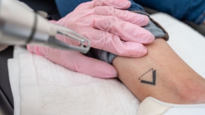 Does Laser Tattoo Removal Work for Tattoos with Multiple Colors?
