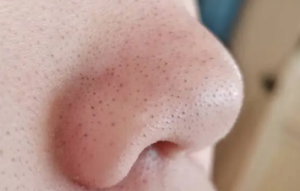 Blackheads vs Whiteheads: Causes, Prevention, and Treatment