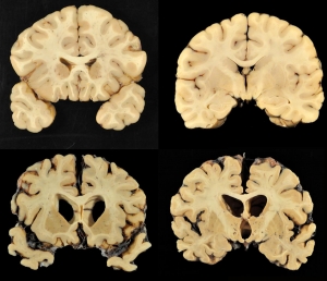 Refractory Epilepsy Market is Anticipated to Witness High Growth Owing to Advancements in Novel Therapeutic Options