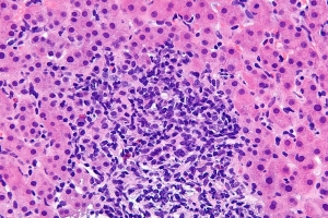Autoimmune Hepatitis Market Is Anticipated to Witness High Growth Owing to Rising Disease Prevalence