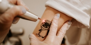 How Laser Tattoo Removal Helps You Achieve Tattoo-Free Skin Faster