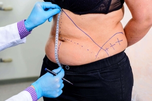 How Liposuction Helps You Achieve a More Proportional Body Shape