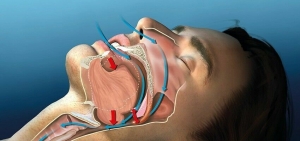 Anti-Snoring Devices Market Set to Surge on Rising Sleep Apnea