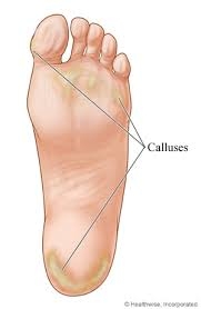 Recognizing When Corns and Calluses Need Medical Attention