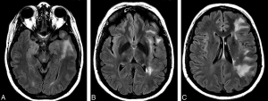 Parry Romberg Syndrome Market to Expand Due to Advanced Diagnostics