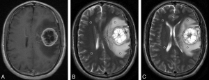 Glioblastoma Market to Grow Rapidly Owing to Immunotherapy Advances