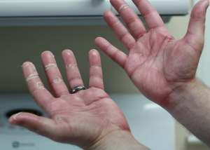 Hand Foot Syndrome Market to Grow with Innovative Therapies