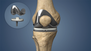 Knee Replacement Surgery: What You Should Know